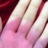 Enfermedad de Raynaud: síntomas, diagnóstico y tratamiento en México