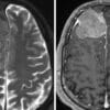 Meningiomas: Todo lo que necesitas saber sobre este tipo de tumor cerebral en México