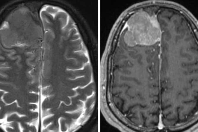 Meningiomas: Todo lo que necesitas saber sobre este tipo de tumor cerebral en México