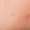 Enfermedad de Lyme: Síntomas, prevención y tratamiento en México