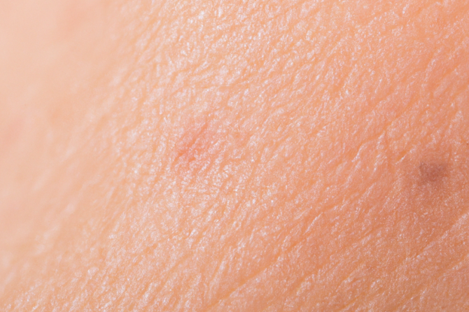 Enfermedad de Lyme: Síntomas, prevención y tratamiento en México